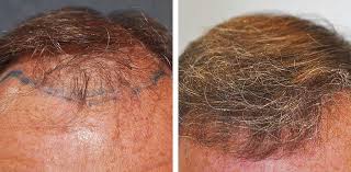 Top 10 Benefits of Choosing Hair Transplant Brighton for Natural Results